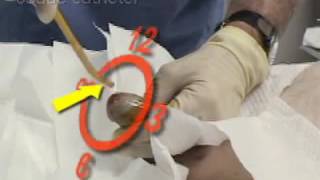 Male Urethral Catheterization  Barbat uretrala cateterizare