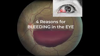 4 Reasons for BLEEDING in the EYE/ Blood clot in the eye