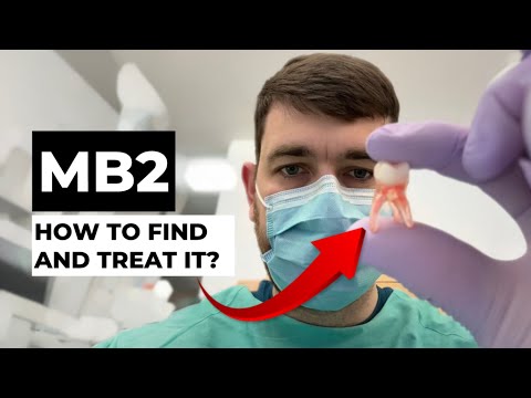 MB2 Canal: How to Find and Treat It? Step-by-Step Guide