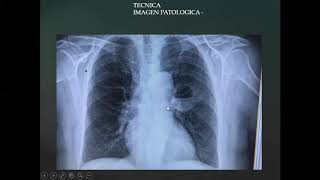 Taller Clínico Imagenológico Respiratorio. Dra. Verónica Torres