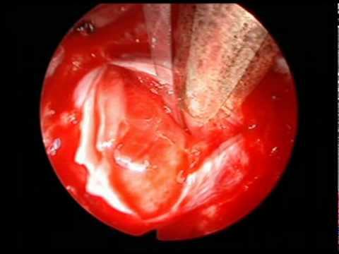 PRLoma - Less Invasive Endoscopic Treatment