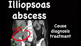 Case ######4 illiopsoas abscess causative agent ,symptoms, diagnosis, treatment