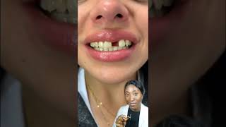 Download lagu Making a FRONT TOOTH DENTURE #shorts #denture #missingtooth #youtubeshorts #teethbits #shortsfeed mp3