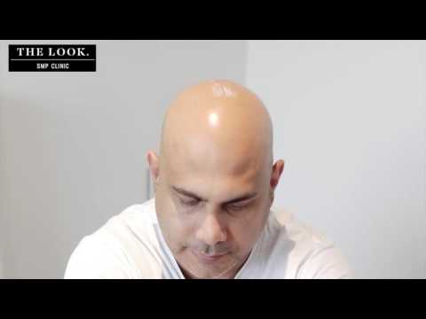 Scalp Micropigmentation - Hair Tattoo - SMP Clinic Melbourne and Sydney
