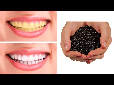 Bleichen Sie Ihre Zähne in 1 Minute! 💯 effektiv! Karies und gelbe Plaque entfernen!