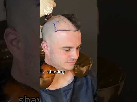 My Hair Transplant Journey From Start to 1 Month!