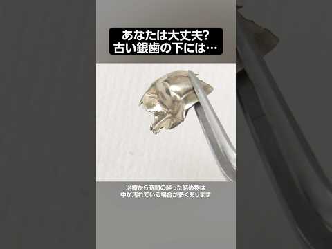 あなたは大丈夫?古い銀歯の下には… #ザホワイトデンタルクリニック #歯医者 #歯石除去  #虫歯 #銀歯