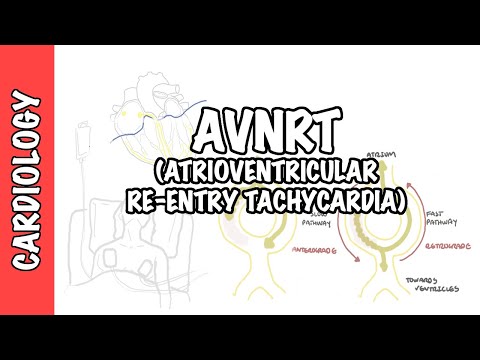 AVRNT (atrioventricular re-entry tachycardia) - przyczyny, patofizjologia, leczenie