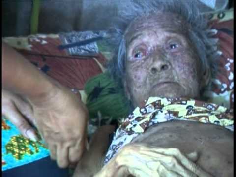 โรคสะเก็ดเงินยาหม่องไทย การแทรกซึมของกลาก