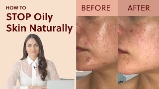 How to Stop Oily Skin Naturally (4 Proven Tips)