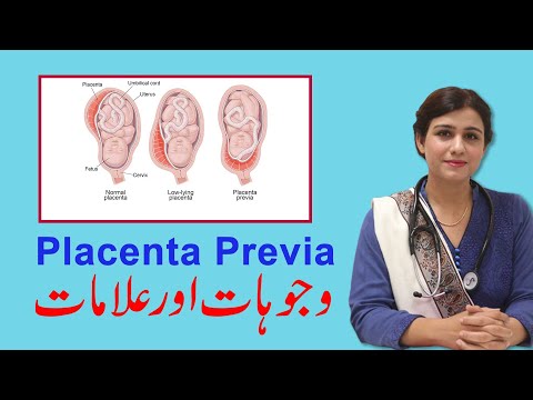 Placenta Previa Reasons & Treatment - Dr Maryam Raana Gynaecologist