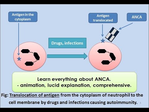 ANCA (Anti Neutrophilic Cytoplasmic Antibody) pathology, vasculitis