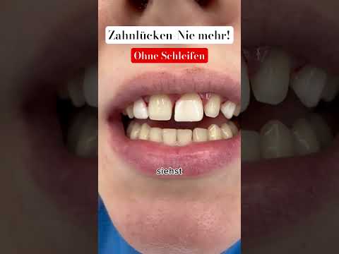 Flowable Injection Technique sei Dank! #flowableinjection #veneers #schönezähne #smiledesigner