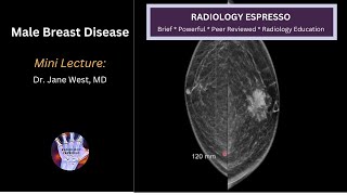 MALE BREAST DISEASE - MALE BREAST CANCER AND GYNECOMASTIA: Mini Lecture, Dr. Jane West, MD