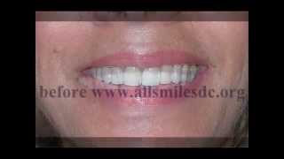 preview picture of video 'cosmetic dentistry before and after www.allsmilesdc.org'