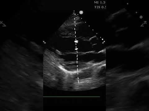 EPSS for LV Ejection Fraction  #pocus #ultrasound #emergencymedicine
