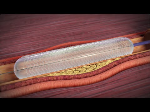 What is a Coronary Angioplasty?