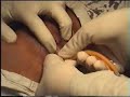 Bladder Catheterization