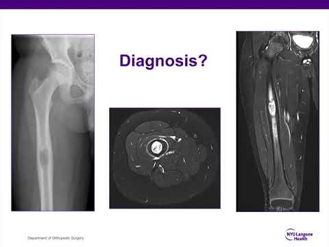 Benign Bone Tumors - ABOS Orthopedic Surgery Board Exam Review