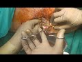 perianal abscess surgery,how I do it