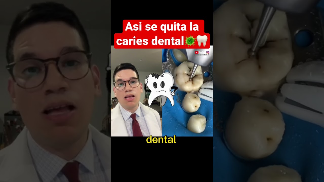 🦷🦠ASÍ SE QUITA LA CARIES DENTAL #shorts