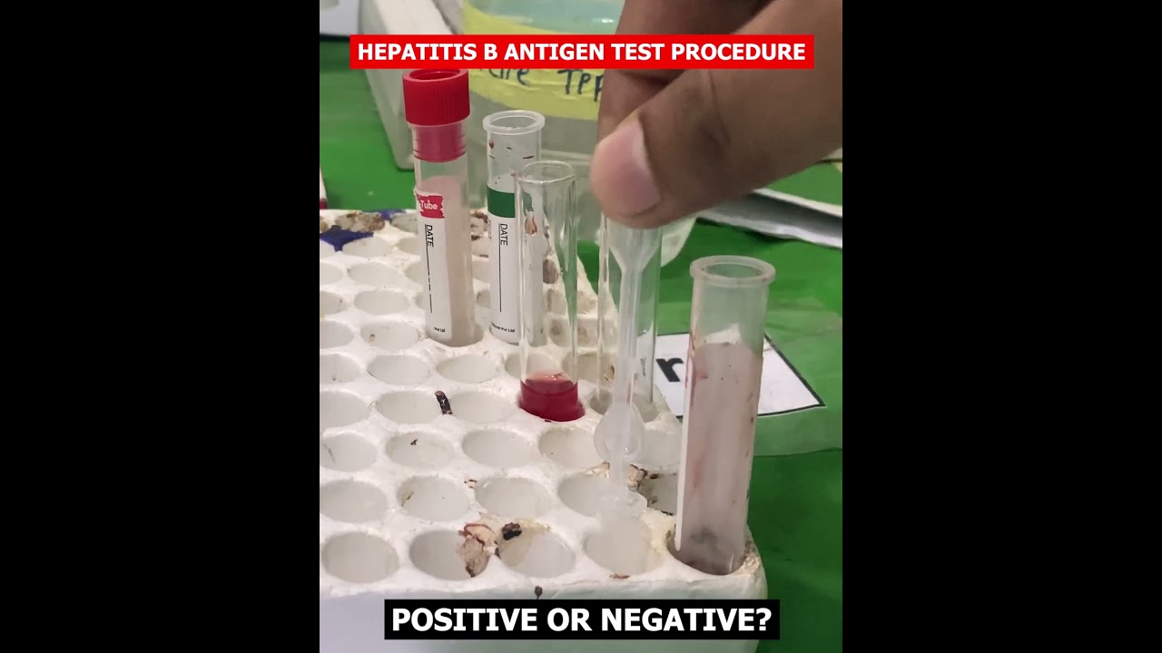 HBsAg test | Hepatitis B virus | Hepatitis B surface antigen test #science #labtest