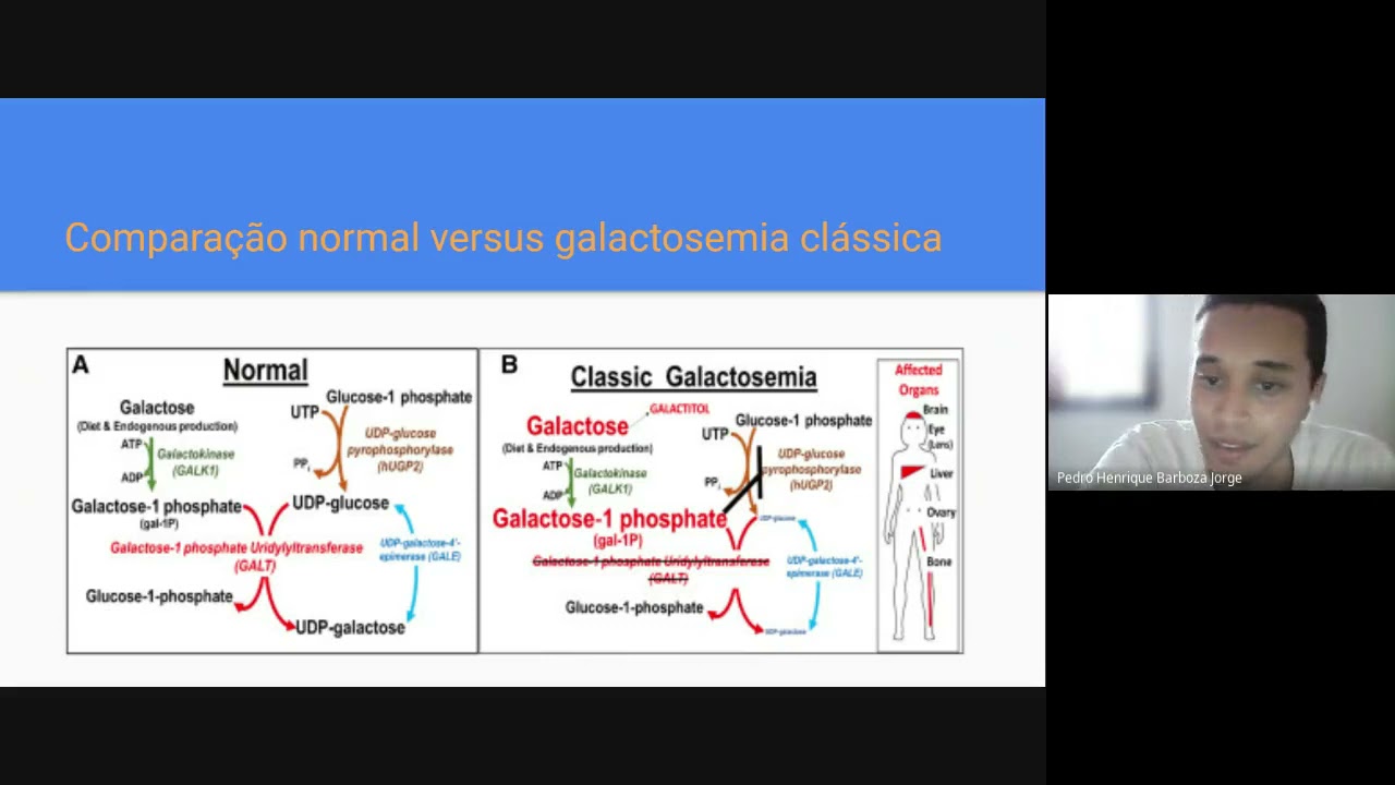 Galactosemia by Pedro & Luca (T3)