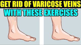 HOW TO GET RID OF VARICOSE VEINS IN LEGS