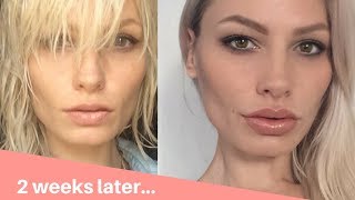 Vlogging Beauty Treatments