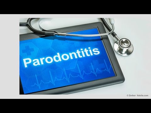 Zahnfleischbluten - Zahnfleischentzündung - Parodontose (Parodontitis) Zahnarzt Garmisch