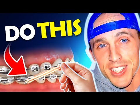 Getting Braces OFF Faster..