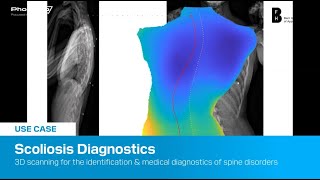 3D scanning for scoliosis diagnostics