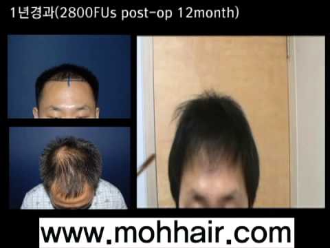 2800FU's. FUE  Hair Transplantation by Dr. Moh
