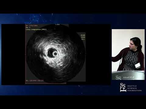 Type B Aortic Dissection - The Masquerade of Malperfusion - Kira Long