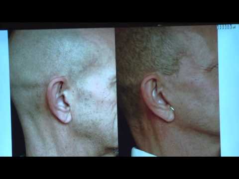 Facelift Incisions