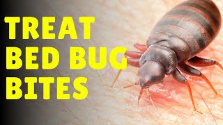How to Treat Bed Bug Bites (Naturally)