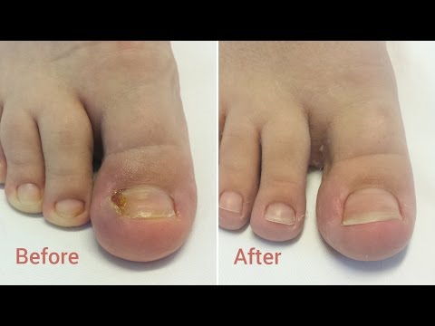 Semne și tratamentul ciupercii unghiilor de la picioare