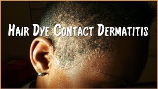 Severe Hair Dye Contact Dermatitis