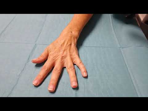 VideoEN 4.2. Daily self-examination of the fistula: arteriovenousfistula with stenosis