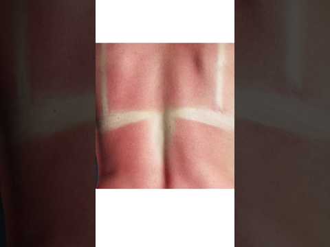 ⚠️Don't do this if you get sunburned #skincare #sunburn #dermatology #onderm