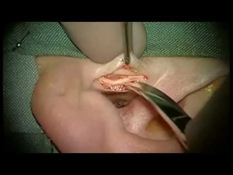 Harvesting Tragal Perichondrium and Cartilage