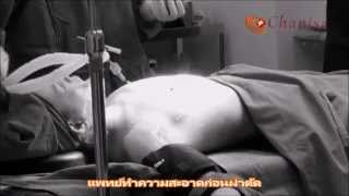 เสริมหน้าอกด้วยถุงซิลิโคนผ่านทางรักแร้ เสริมหน้าอกด้วยถุงซิลิโคนผ่านทางรักแร้