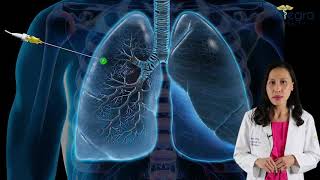Download the video "Diagnosing Lung Cancer by early identification of pulmonary nodules."