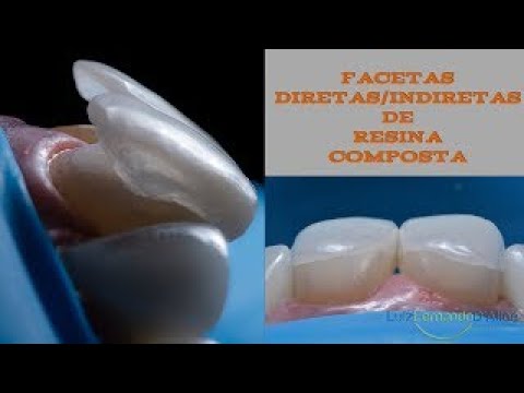 Faceta Direta Indireta de Resina Composta