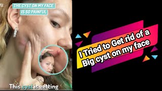 I tried to get rid of a big cyst on my face - and the internet became obsessed with it