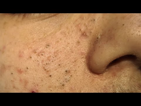 Gentle ASMR Blackhead Removal * ASMR Relaxation *