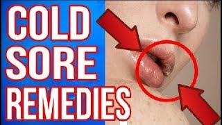 7 NATURAL WAYS To Get Rid of COLD SORES | COLD SORE FAST REMEDIES