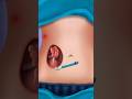 How To Treat The Appendix Surgery In 3D Animation Shorts Appendixe Surgery