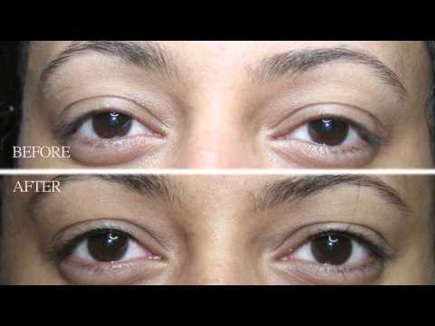 Permanent Makeup -The Dermatography Clinic, Spitalfields, London