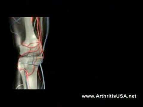 Knee pain due to knock knees by dr Farshchian